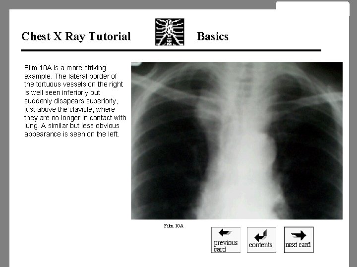 Chest X Ray Tutorial Basics Film 10 A is a more striking example. The