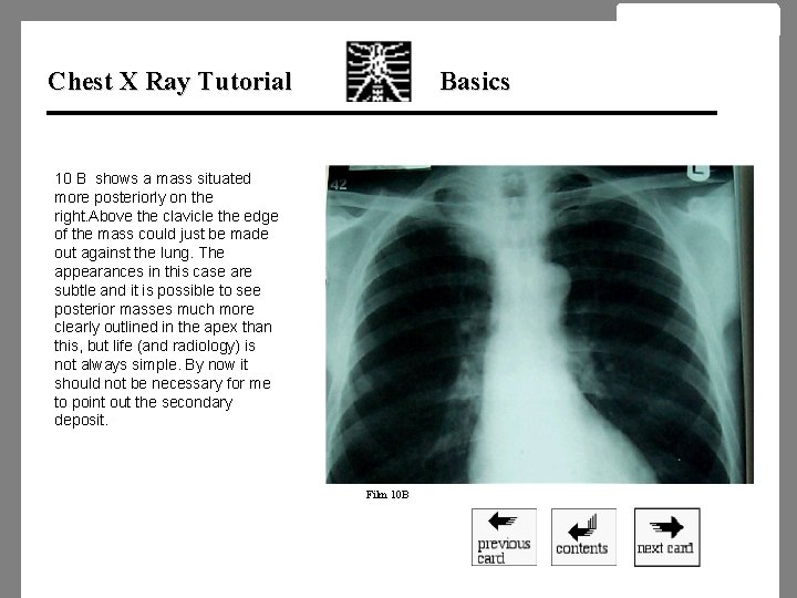 Chest X Ray Tutorial Basics 10 B shows a mass situated more posteriorly on