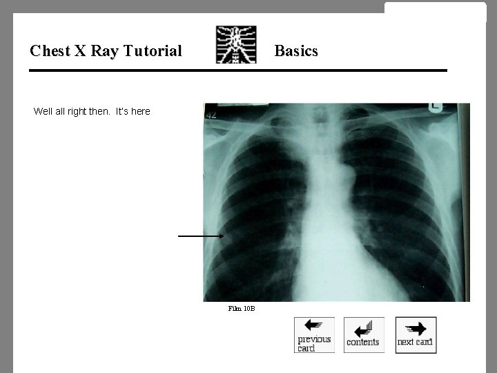 Chest X Ray Tutorial Basics Well all right then. It’s here Film 10 B