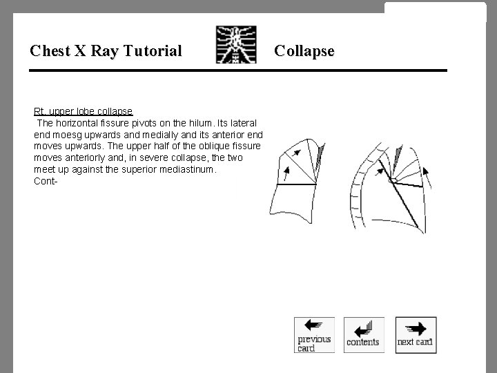 Chest X Ray Tutorial Rt. upper lobe collapse The horizontal fissure pivots on the