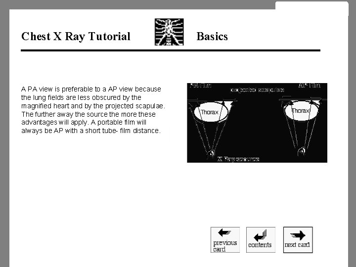 Chest X Ray Tutorial A PA view is preferable to a AP view because