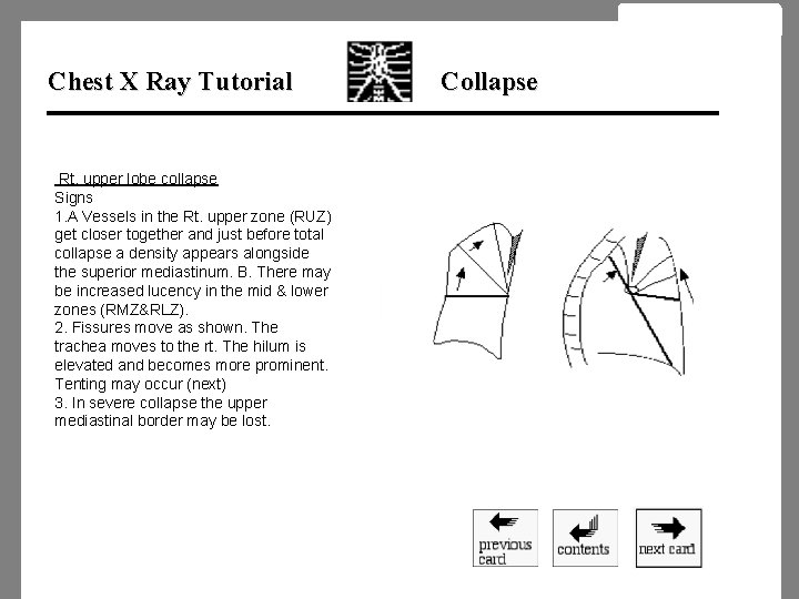 Chest X Ray Tutorial Rt. upper lobe collapse Signs 1. A Vessels in the