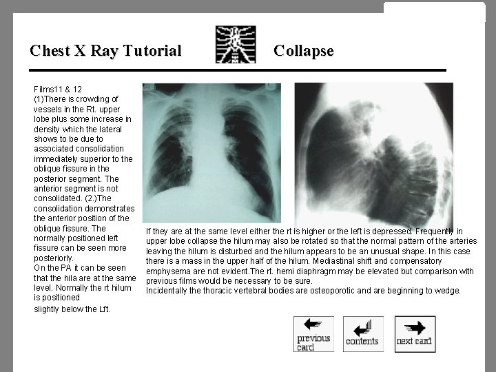 Chest X Ray Tutorial Films 11 & 12 (1)There is crowding of vessels in