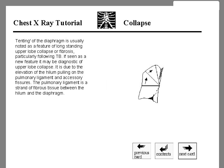 Chest X Ray Tutorial Tenting' of the diaphragm is usually noted as a feature