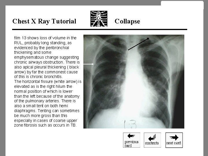 Chest X Ray Tutorial film 13 shows loss of volume in the RUL, probably