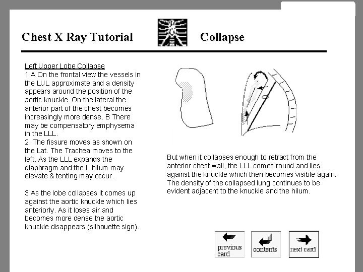 Chest X Ray Tutorial Left Upper Lobe Collapse 1. A On the frontal view