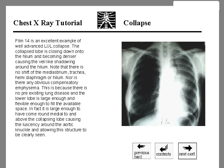 Chest X Ray Tutorial Film 14 is an excellent example of well advanced LUL