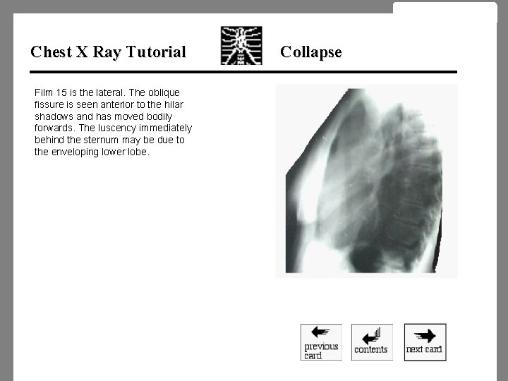 Chest X Ray Tutorial Film 15 is the lateral. The oblique fissure is seen