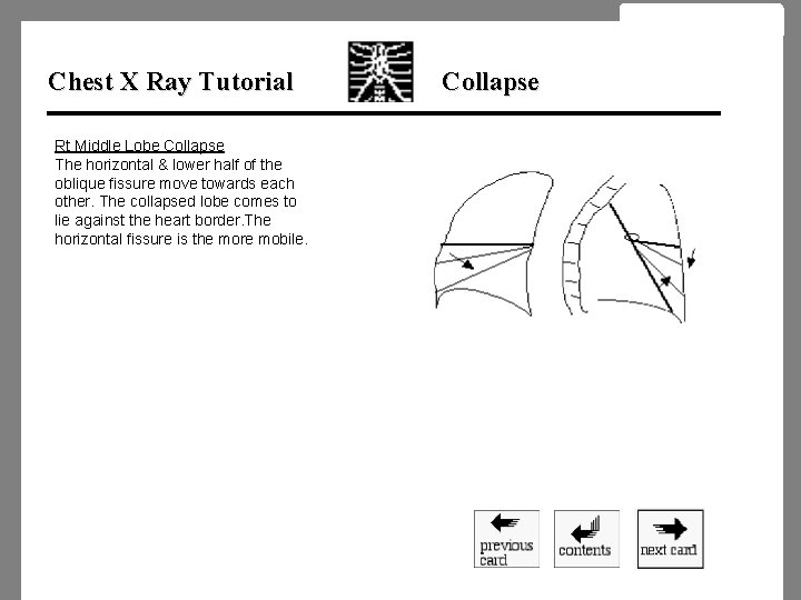 Chest X Ray Tutorial Rt Middle Lobe Collapse The horizontal & lower half of Chest X Ray Tutorial Rt Middle Lobe Collapse The horizontal & lower half of