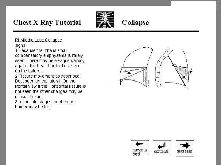 Chest X Ray Tutorial Rt Middle Lobe Collapse signs 1 Because the lobe is