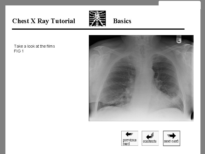 Chest X Ray Tutorial Take a look at the films FIG 1 Basics 