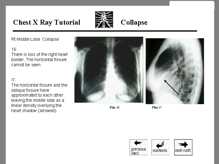 Chest X Ray Tutorial Collapse Rt Middle Lobe Collapse 16. There is loss of