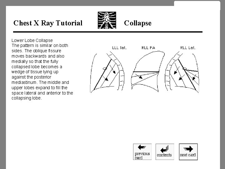 Chest X Ray Tutorial Lower Lobe Collapse The pattern is similar on both sides.