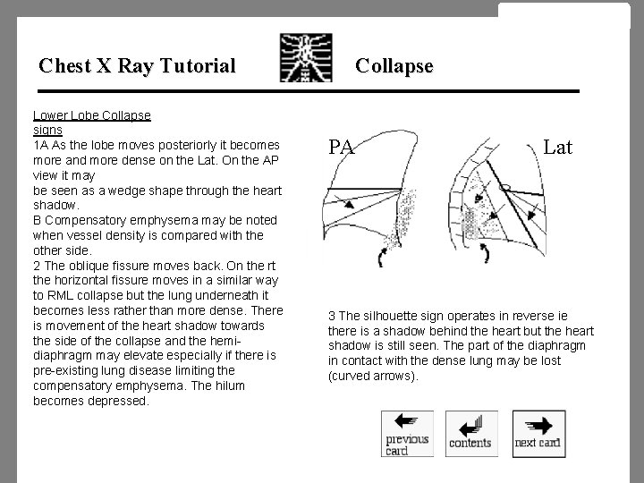 Chest X Ray Tutorial Lower Lobe Collapse signs 1 A As the lobe moves