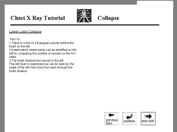 Chest X Ray Tutorial Lower Lobe Collapse Film 18. 1. There is a hint