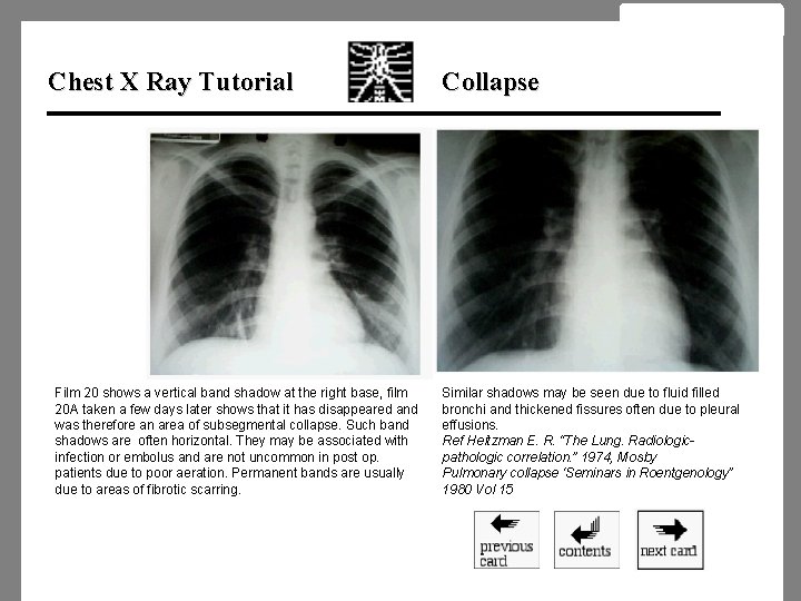 Chest X Ray Tutorial Film 20 shows a vertical band shadow at the right