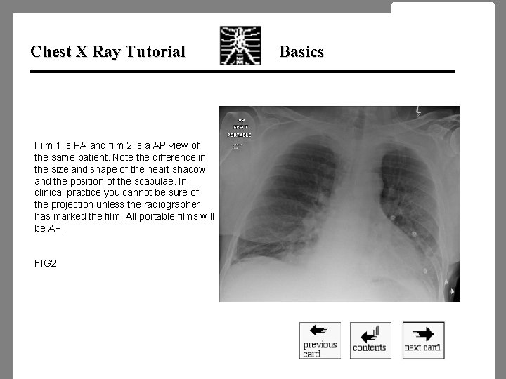 Chest X Ray Tutorial Film 1 is PA and film 2 is a AP