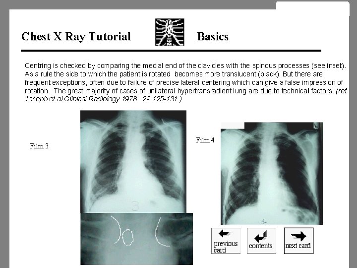 Chest X Ray Tutorial Basics Centring is checked by comparing the medial end of