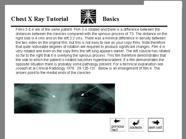 Chest X Ray Tutorial Basics Films 3 & 4 are of the same patient.