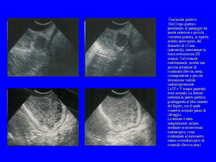 Carcinoide gastrico. Nel Corpo gastrico prossimale, al passaggio tra parete anteriore e piccola curvatura