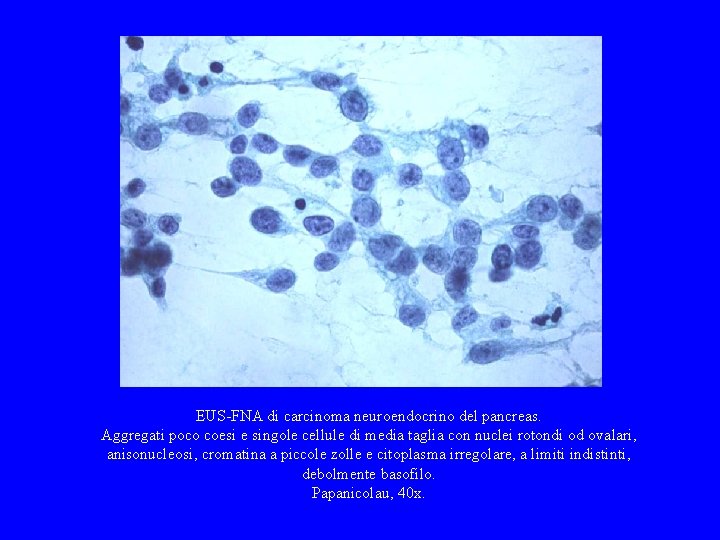 EUS-FNA di carcinoma neuroendocrino del pancreas. Aggregati poco coesi e singole cellule di media