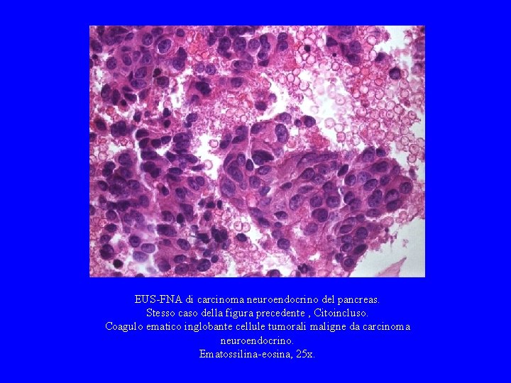 EUS-FNA di carcinoma neuroendocrino del pancreas. Stesso caso della figura precedente , Citoincluso. Coagulo