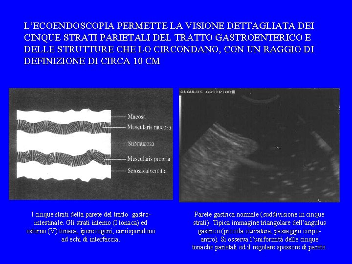 L’ECOENDOSCOPIA PERMETTE LA VISIONE DETTAGLIATA DEI CINQUE STRATI PARIETALI DEL TRATTO GASTROENTERICO E DELLE