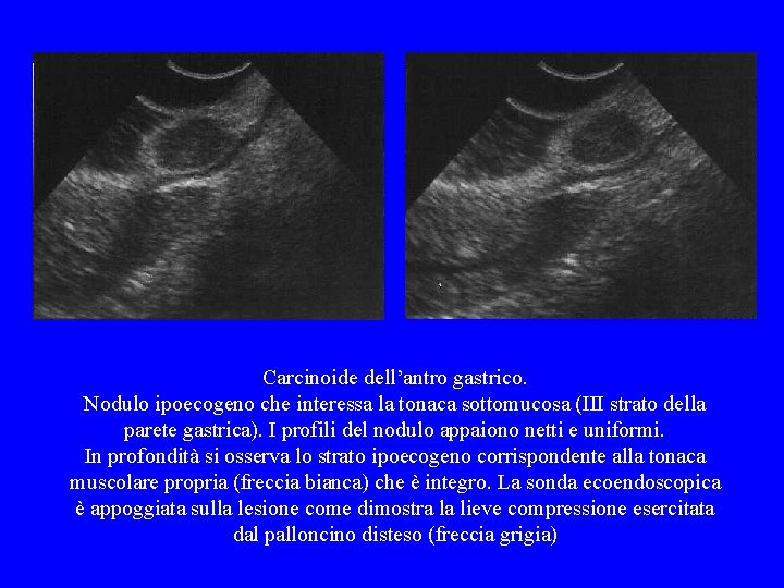 Carcinoide dell’antro gastrico. Nodulo ipoecogeno che interessa la tonaca sottomucosa (III strato della parete