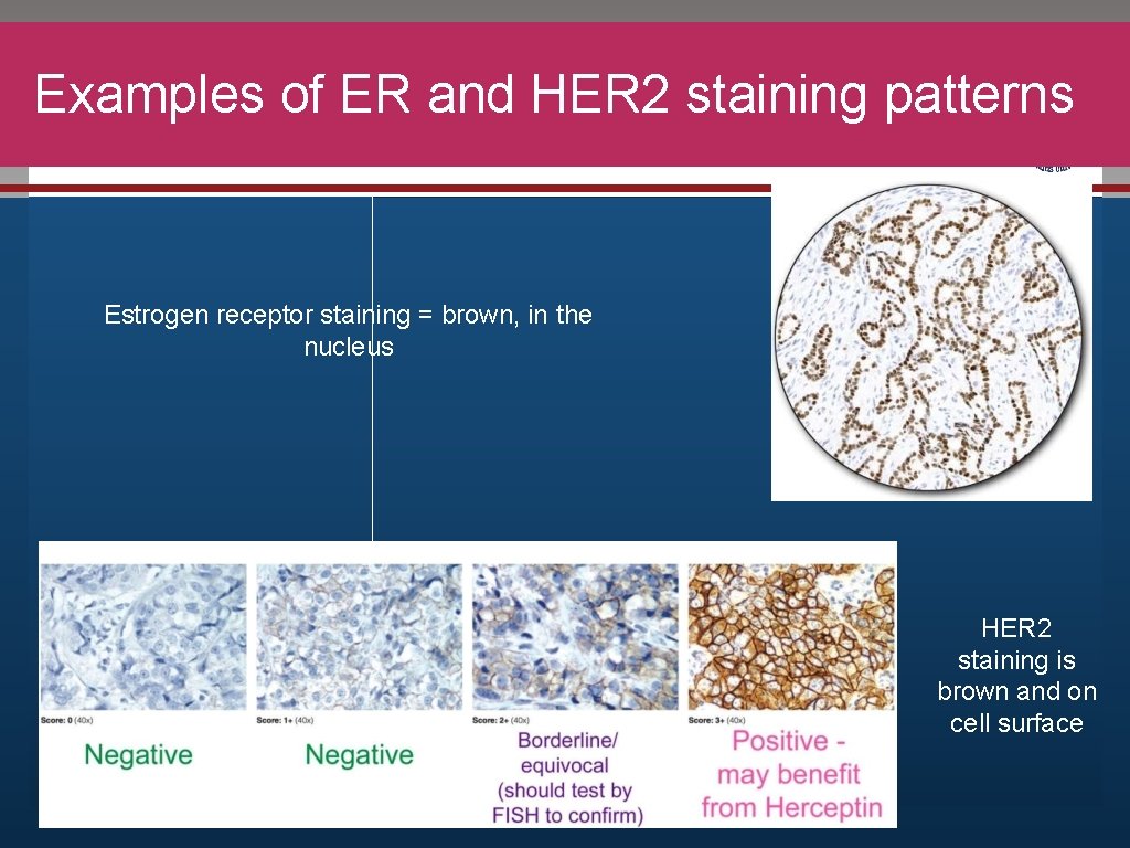 Examples of ER and HER 2 staining patterns Click to edit Master title style