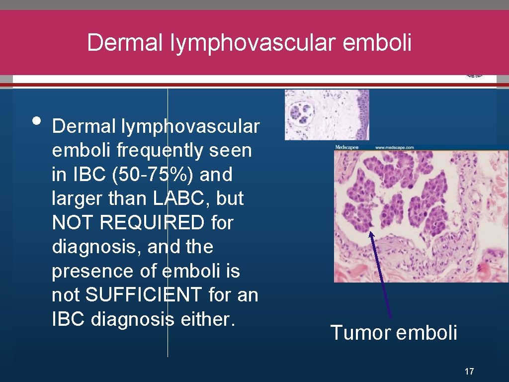 Dermal lymphovascular emboli Click to edit Master title style • Dermal lymphovascular • Edit