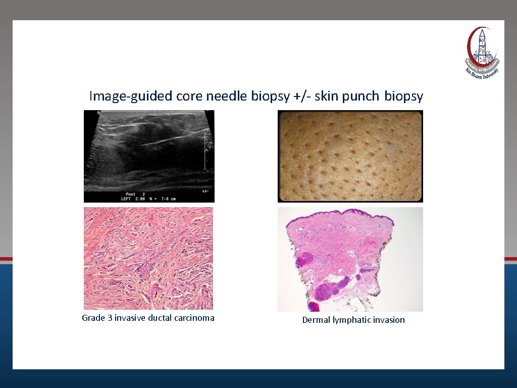 Histologic Evaluation Image-guided core needle biopsy +/- skin punch biopsy Grade 3 invasive ductal