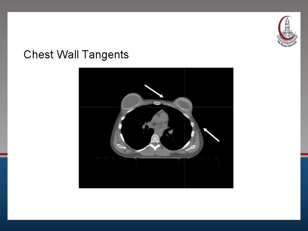 Chest Wall Tangents 