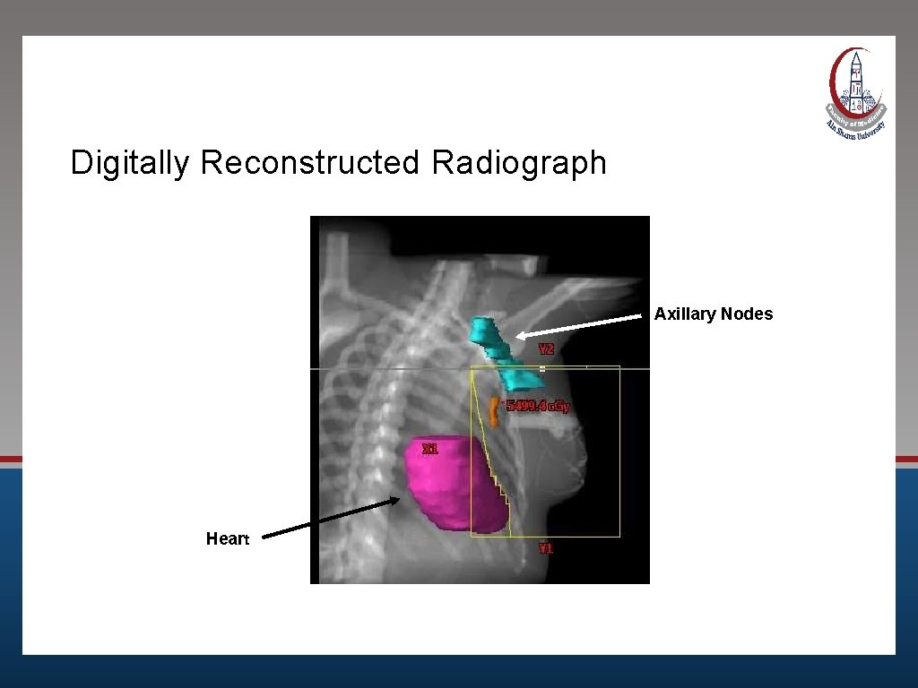 Digitally Reconstructed Radiograph Axillary Nodes Heart 