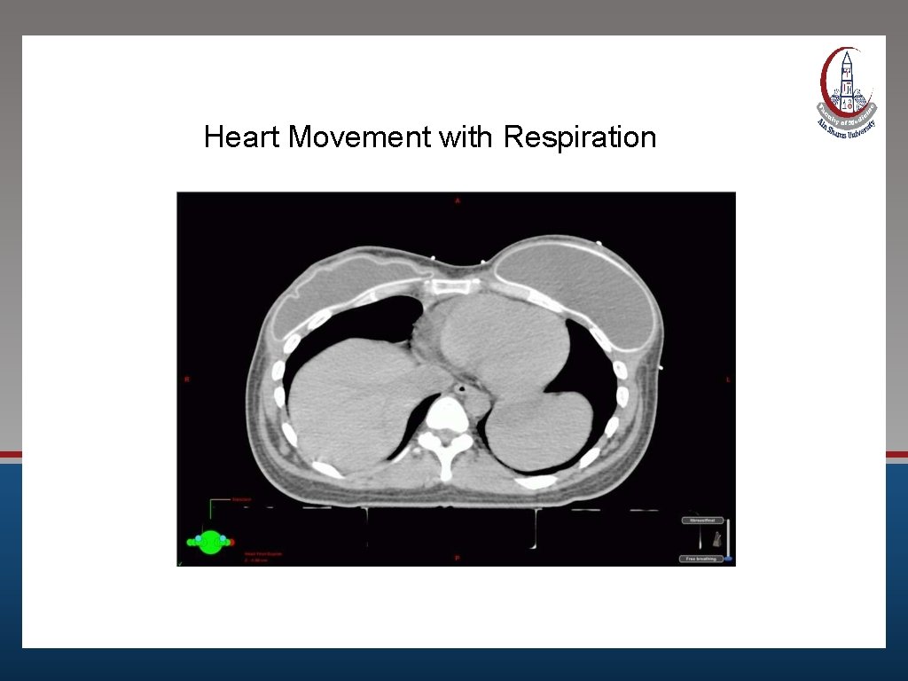 Heart Movement with Respiration 