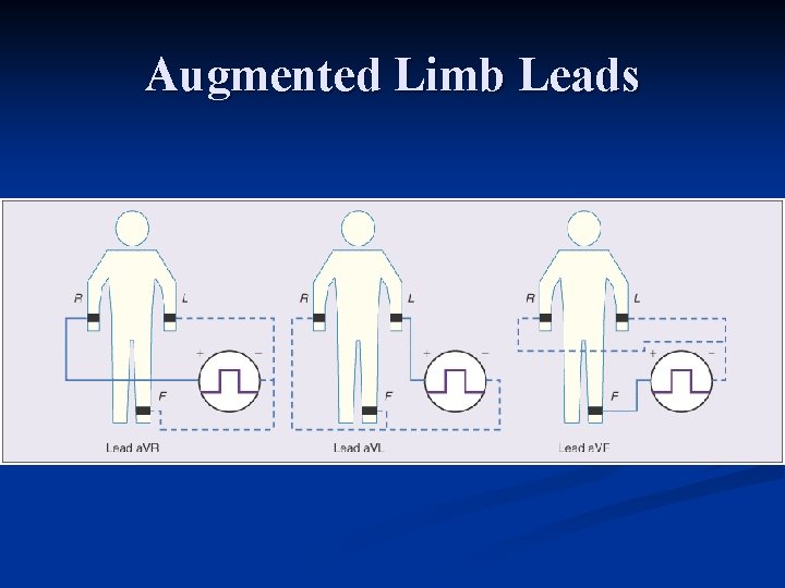 Augmented Limb Leads 