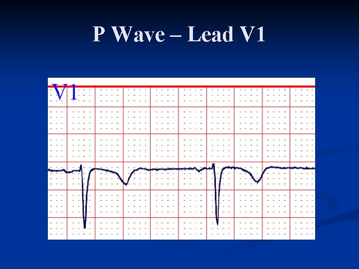 P Wave – Lead V 1 
