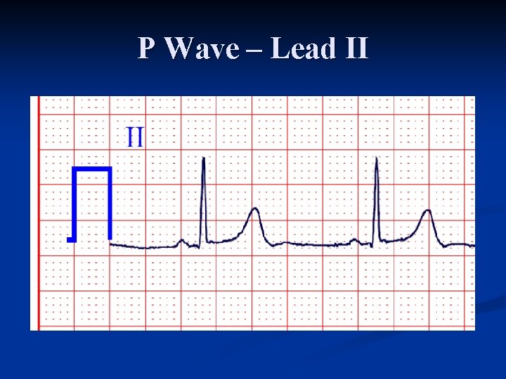 P Wave – Lead II 