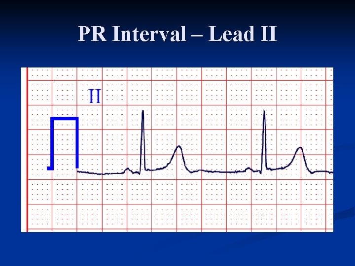 PR Interval – Lead II 