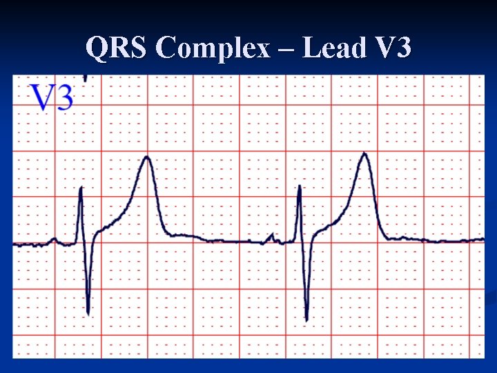 QRS Complex – Lead V 3 