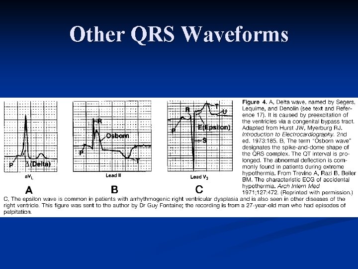 Other QRS Waveforms 