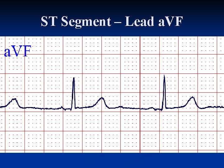 ST Segment – Lead a. VF 
