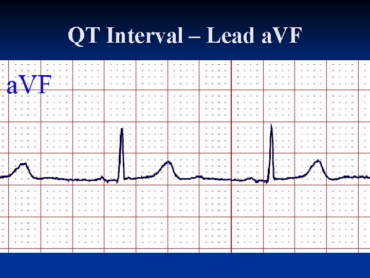 QT Interval – Lead a. VF 