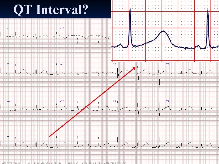 QT Interval? 