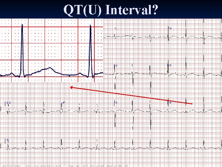 QT(U) Interval? 