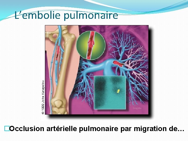 L’embolie pulmonaire �Occlusion artérielle pulmonaire par migration de… L’embolie pulmonaire �Occlusion artérielle pulmonaire par migration de…