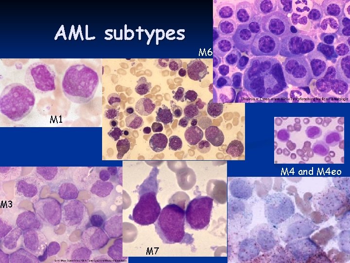 AML subtypes M 6 M 1 M 4 and M 4 eo M 3