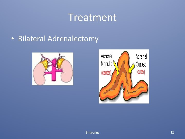 Treatment • Bilateral Adrenalectomy Endocrine 12 
