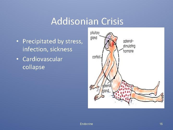 Addisonian Crisis • Precipitated by stress, infection, sickness • Cardiovascular collapse Endocrine 16 