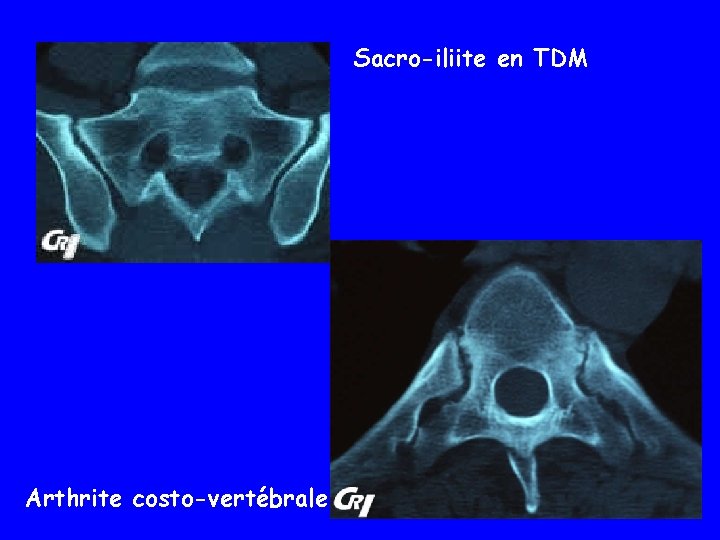 Sacro-iliite en TDM Arthrite costo-vertébrale 