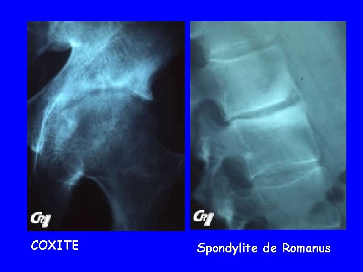 COXITE Spondylite de Romanus 
